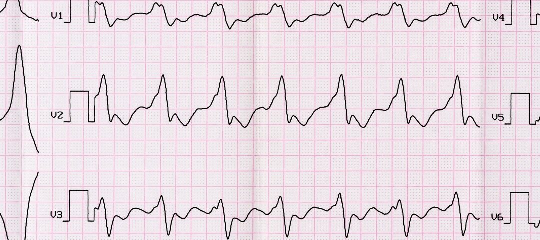 Atrial Septal Defekt (ASD)