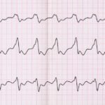 Atrial Septal Defekt (ASD)