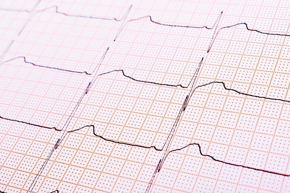 Atrioventriküler Septal Defekt (AVSD)