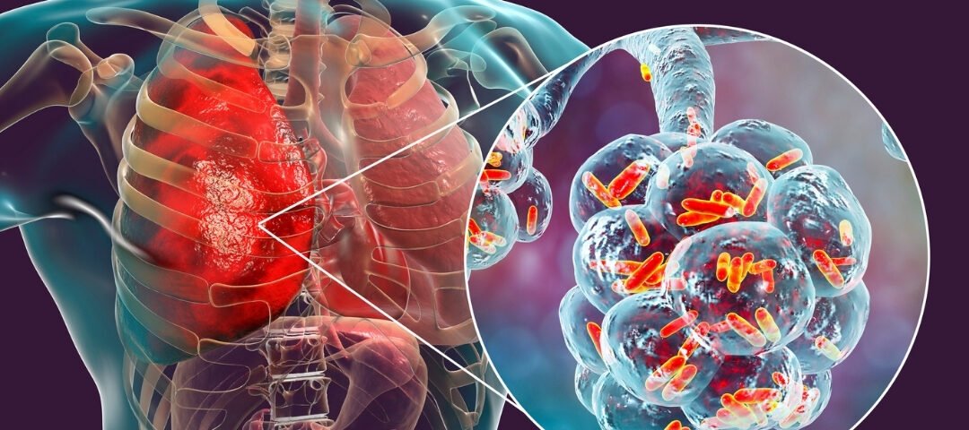 Pulmoner Atrezi Sabah Gazetesi