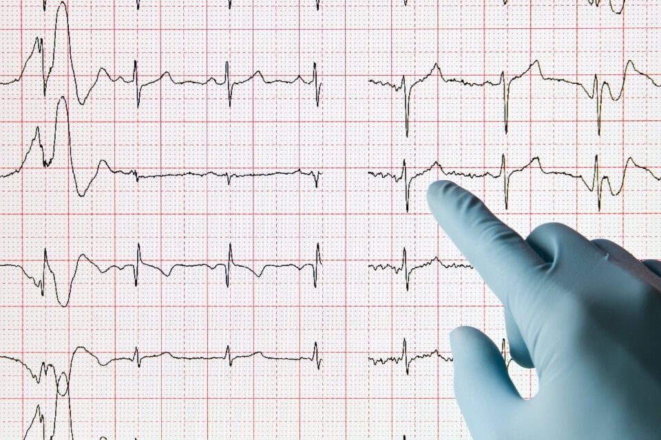 Ventriküler Septal Defekt (VSD)