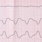 VSD (Ventriküler Septal Defekt) Kalpte Delik