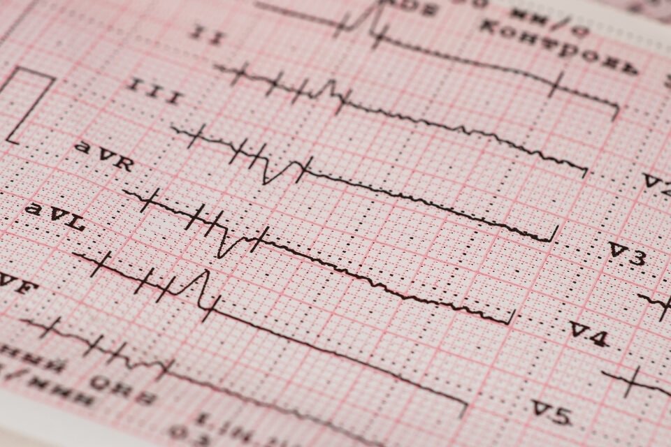 EKG (Elektrokardiyografi)