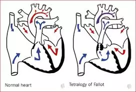 Fallot tetralojisinin dört kusuru