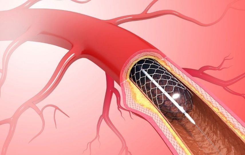 Koroner Arter Hastalığının Tedavisi; Stent mi? By-pass mı?