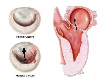 Mitral kapak prolapsusu nedir