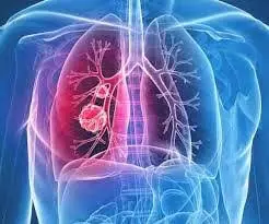 Pulmoner Emboli