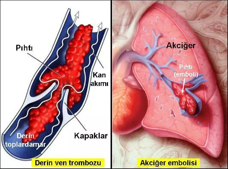 Pulmoner emboli-2