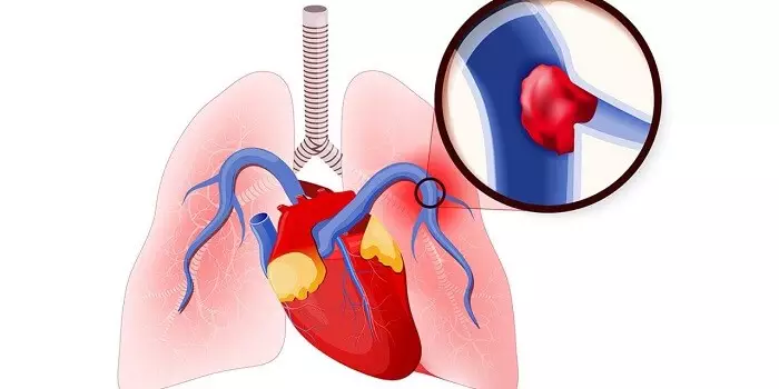 Pulmoner emboli nasıl tedavi edilir?