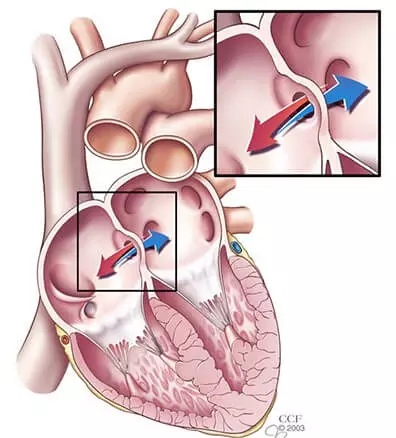 Septal kusurlar