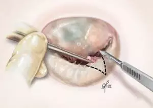 Üçgen Rezeksiyon Mitral Kapak Onarımı