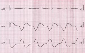 Ventriküler Septal Defektler (VSD)